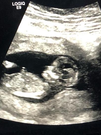 An ultrasound picture posted by Ms Robinson-Williams to Instagram.