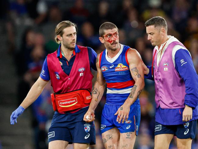 Tom Liberatore of the Bulldogs leaves the field under the blood rule in Round 8. Picture: Dylan Burns/AFL Photos via Getty Images.