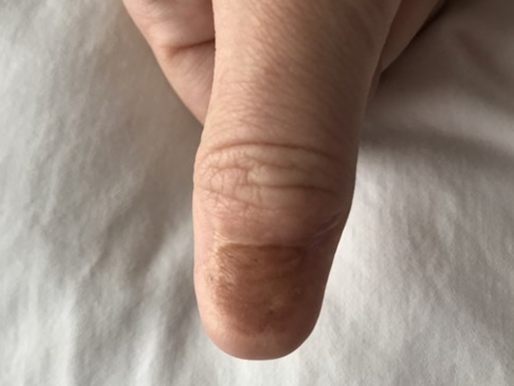 Melanoma symptoms: Woman mistakes cancer for bruise under her nail ...