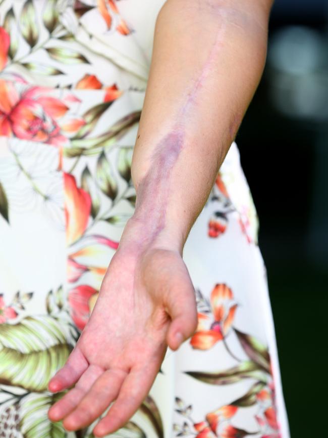 Sabella’s arm after the surgery.