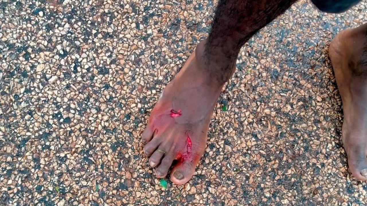 Dennis was treated for a croc bite at a Kalkarindji clinic after an attack while he was escaping the floods. Picture: Supplied.