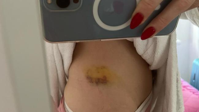 Images of Irina Ozen, depicting what she alleges are injuries caused by alleged assaults committed by her husband and high profile barrister Ertunc Ozen.