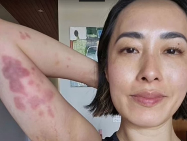 Melissa Leong shares shocking fight injuries