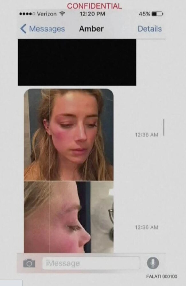 Amber Heard's nurse revealed photos the actor sent her in the wake of an alleged altercation with Johnny Depp. Picture: Supplied