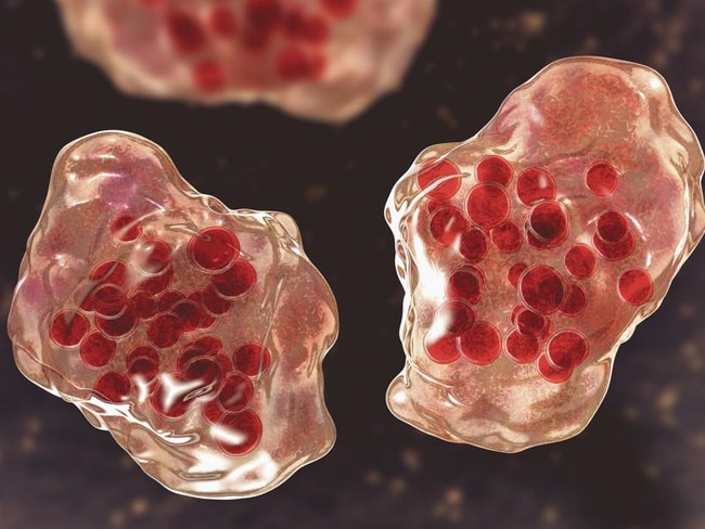Illustration of measles virus infection showing giant multinucleated cells seen during microscopy of biopsy specimens, known as Warthin-Finkeldey giant cells. Picture: Getty