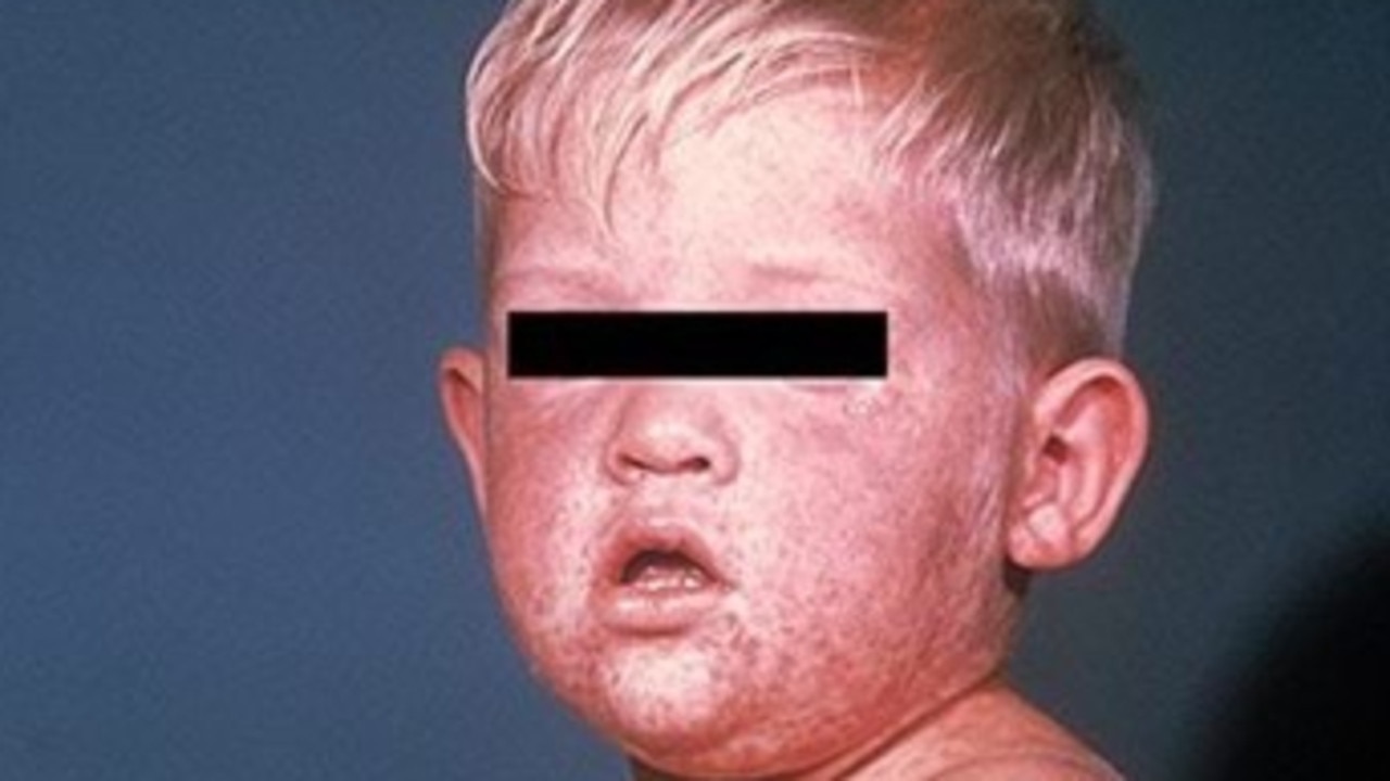 Measles can be particularly dangerous in children.