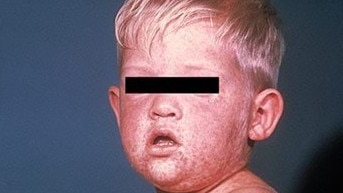 Measles can be particularly dangerous in children.