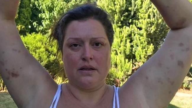 Tziporah Malkah displays bruising she claims was at the hands of heavy handed police during her arrest at Port Elliot in January. Picture: Instagram