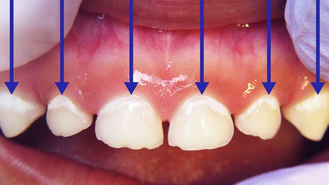 White lines on the top teeth near the gum line can be an early sign of decay in children's teeth. Picture: SA Dental.