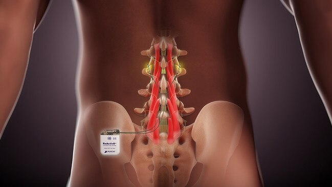 ReActiv8 has been put on the Prosthetic List in Australia as of July 1. The implantable device treats chronic lower back pain, according to the manufacturers.