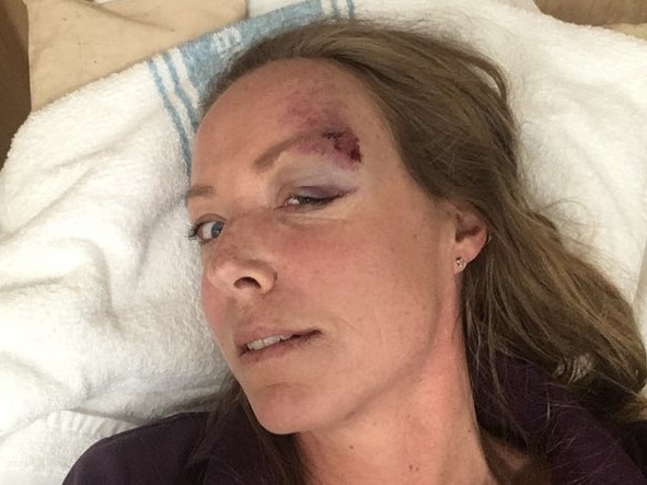 Ms Lang suffered head and neck injuries after her station wagon spun out on Fagans Rd, Lisarow, in 2018. Picture: supplied