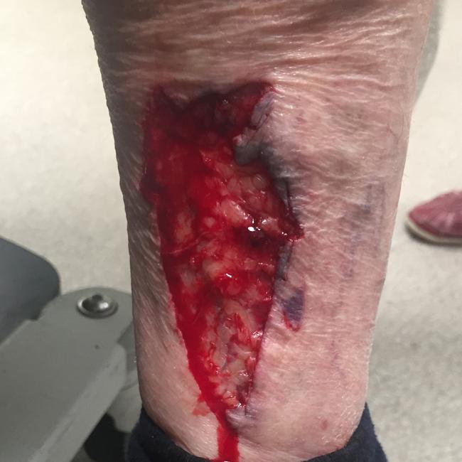 The 78-year-old woman’s injured leg. Picture: Supplied