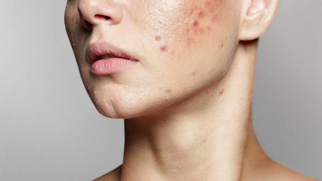 Acne is definitely not only for teenagers. Picture: Getty Images