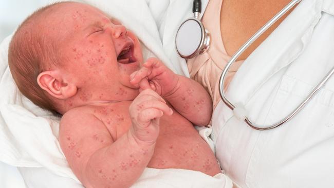 Newborn baby with measles. Picture: istock