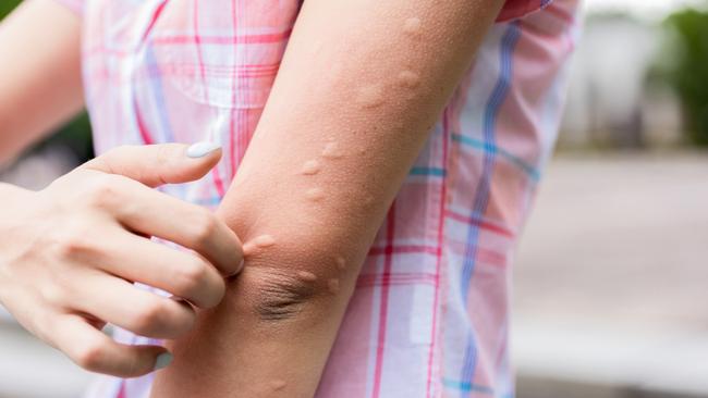 Mosquito bites on the arm