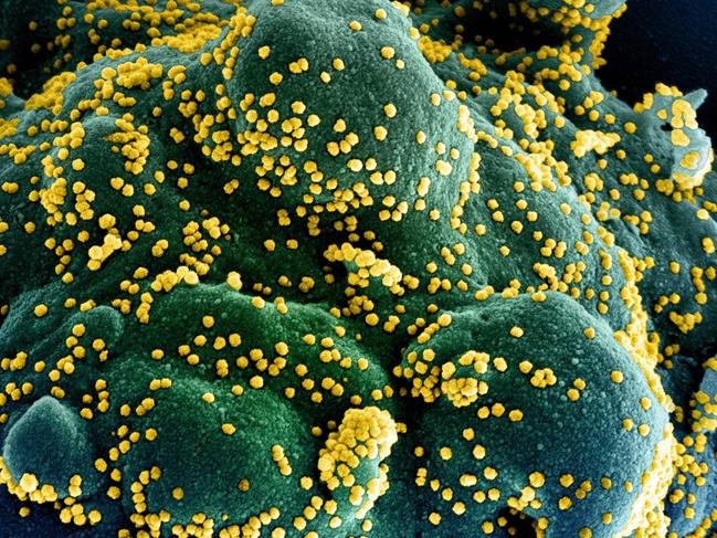 (FILES) In this undated handout image obtained July 15, 2020, courtesy of National Institute of Allergy and Infectious Diseases(NIH/NIAID), shows a colorized scanning electron micrograph of an apoptotic cell (blue/green) heavily infected with SARS-COV-2 virus particles (yellow), isolated from a patient sample, captured at the NIAID Integrated Research Facility (IRF) in Fort Detrick, Maryland. - US pharmaceutical company Eli Lilly's combination of two synthetic antibodies against Covid-19 reduced hospitalizations and deaths by 70 percent in high-risk patients with recent positive tests, the company said on January 26, 2021. "Bamlanivimab and etesevimab together have the potential to be an important treatment that significantly reduces hospitalizations and death in high-risk COVID-19 patients," Lilly's chief scientific officer Daniel Skovronsky said. (Photo by Handout / National Institute of Allergy and Infectious Diseases / AFP) / RESTRICTED TO EDITORIAL USE - MANDATORY CREDIT "AFP PHOTO /NATIONAL INSTITUTE OF ALLERGY AND INFECTIOUS DISEASES/HANDOUT " - NO MARKETING - NO ADVERTISING CAMPAIGNS - DISTRIBUTED AS A SERVICE TO CLIENTS