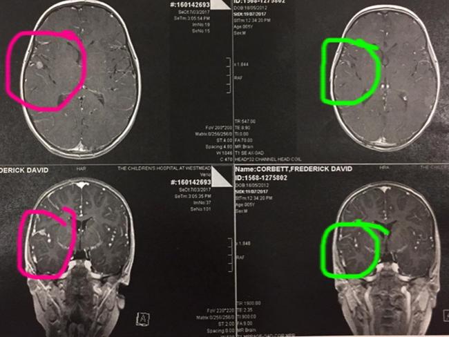 Fred Corbett’s MRI scans from July 19. The pink circles were the relapse spot, the green circles show it has diminished.