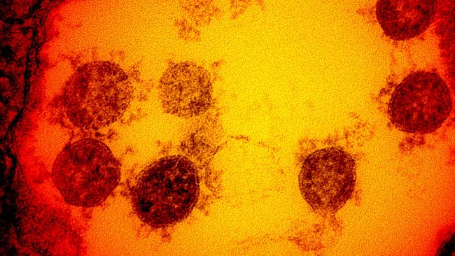 (FILES) In this undated handout image obtained July 15, 2020, courtesy of National Institute of Allergy and Infectious Diseases(NIH/NIAID), shows a transmission electron micrograph of SARS-CoV-2 virus particles, isolated from a patient, captured and color-enhanced at the NIAID Integrated Research Facility (IRF) in Fort Detrick, Maryland. - US pharmaceutical firm Eli Lilly on October 13, 2020 paused a late-stage trial of its experimental lab-produced antibody treatment against Covid-19 over an unspecified safety concern, the company said. "Lilly is supportive of the decision by the independent DSMB (data safety monitoring board) to cautiously ensure the safety of the patients participating in this study," a spokesperson told AFP in a statement. (Photo by Handout / National Institute of Allergy and Infectious Diseases / AFP) / RESTRICTED TO EDITORIAL USE - MANDATORY CREDIT "AFP PHOTO /NATIONAL INSTITUTE OF ALLERGY AND INFECTIOUS DISEASES/HANDOUT " - NO MARKETING - NO ADVERTISING CAMPAIGNS - DISTRIBUTED AS A SERVICE TO CLIENTS