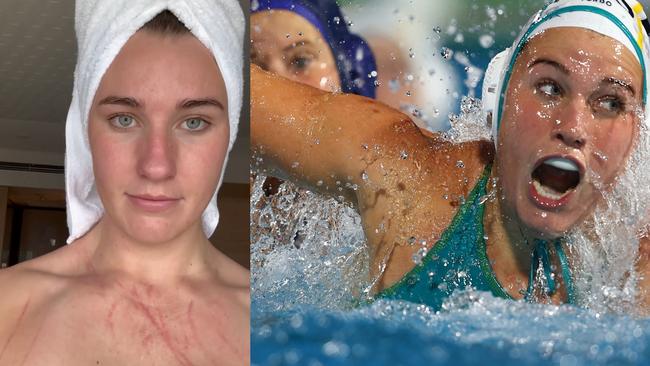 Tilly Kearns took to social media to display her scars from a brutal match.