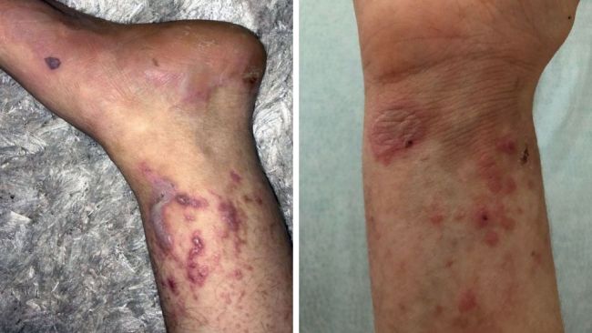 Nurbanu Istar Lives With The Skin Condition That’s Like Having ‘Third ...