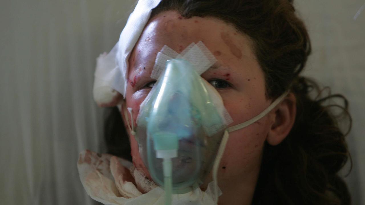 OCTOBER 2, 2005 : Jessica Fitzgerald (13) in burns unit at Sanglah Hospital in Denpasar, Bali 02/10/05, injured along with father in terrorist bombings that left her teenage brother dead 02/10/05. Pic Ardiles Rante.