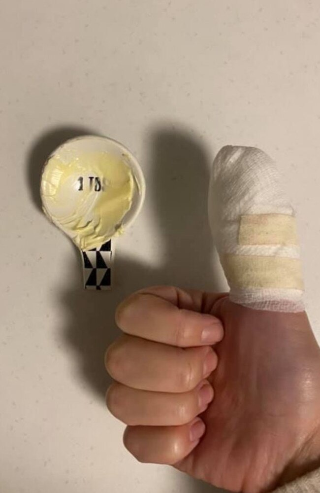 Jaime Burgess posted photos of her thumb and the spoon on Facebook to warn others. Picture: Facebook/Kmart Home Decor &amp; Hacks