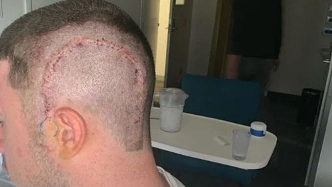 Jack Higgins revealed the scar from his brain surgery on Instagram.