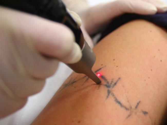 Clinical Nurse Coordinator Clare Delany uses the PicoSure Tatoo Removal machine on client Angela Pleshkova at Advanced Aesthetics, Pindara Specialist Suites.Photo: Kit Wise