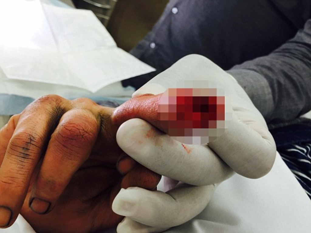 An image showing Johnny Depp’s horrific finger injury. Picture: TMZ