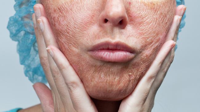 Women are buying chemical peel products off eBay.