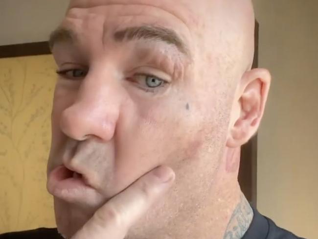 Lucas Browne reveals his injuries.