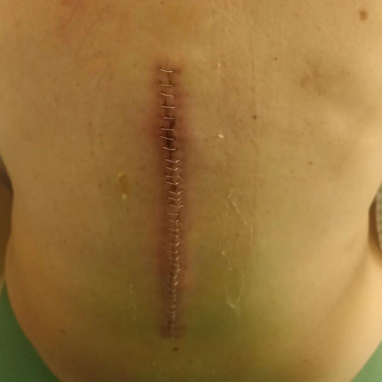 On the day of the crash he underwent a back operation to stabilise an L1 fracture. Picture: Instagram/nneynens