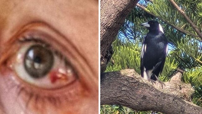 The magpie left the woman's eye bloody. Picture: Supplied