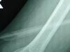 An x-ray of  Pam Bennett's arm showing a stingray barb near the bone. (Supplied: Pam Bennett)