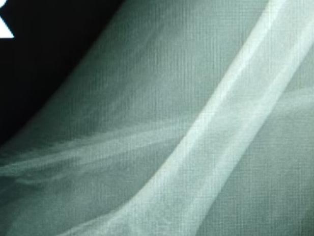 An x-ray of  Pam Bennett's arm showing a stingray barb near the bone. (Supplied: Pam Bennett)