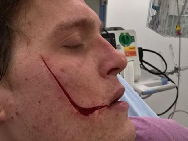 Liam Newby who suffered horrific injuries to his right cheek after being slashed from his right eye to his mouth by a gang of vicious thugs.