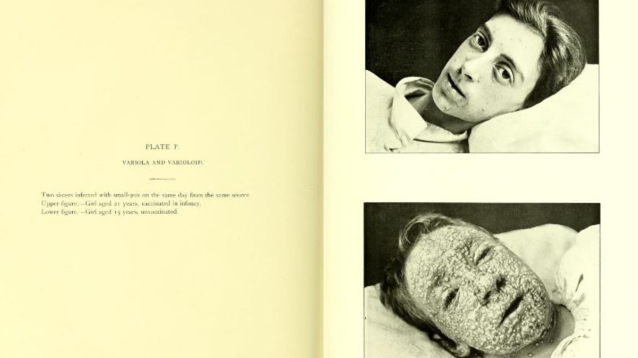 Photos show siblings vaccinated and unvaccinated with smallpox in 1901. Picture: Dr Allan Warner/Atlas of Clinical Medicine, Surgery, and Pathology