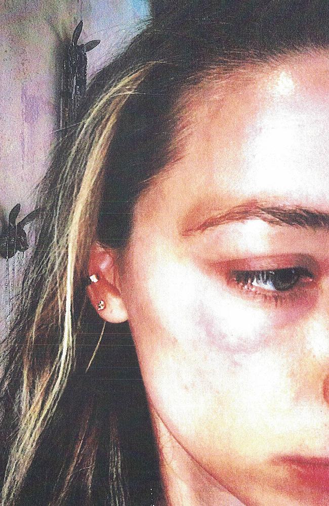 Bruising on Amber Heard's face she claims was inflicted by Johnny Depp.