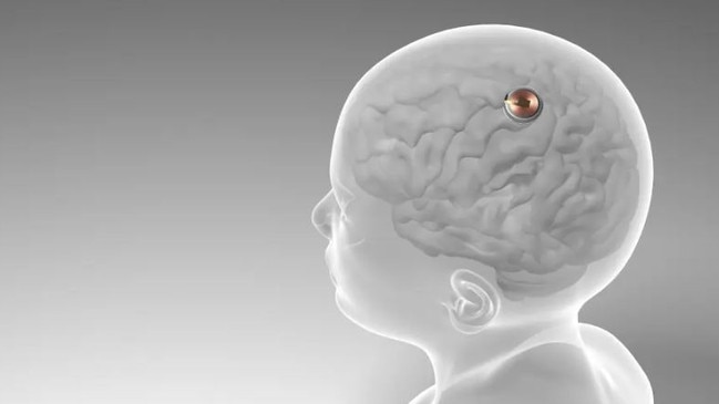 Neuralink said its brain-computer interface, known as a BCI — which uses electrodes and threads to gather data about the brain’s neural activity and movement — suffered an unexpected setback.