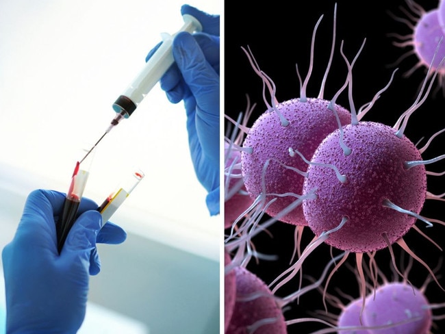 ‘Stubborn, distressing’ infection affecting women is actually an STI. Picture: iStock