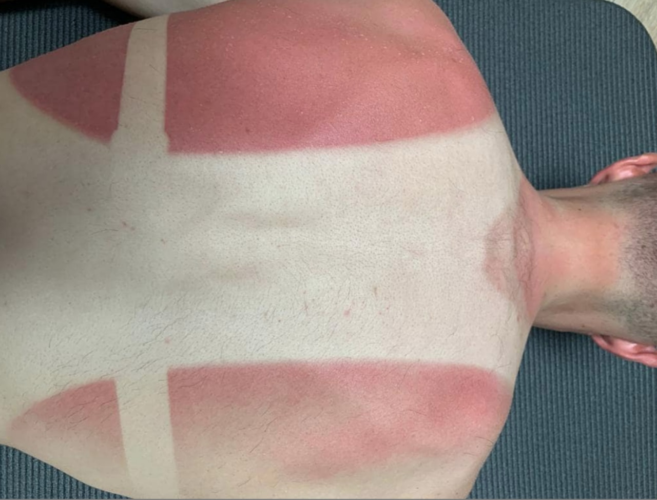 Enric Mas shows off his sunburn.