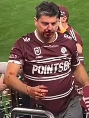 A Manly fan was left bloodied after an unfortunate clash in the Round 1 Las Vegas opener.