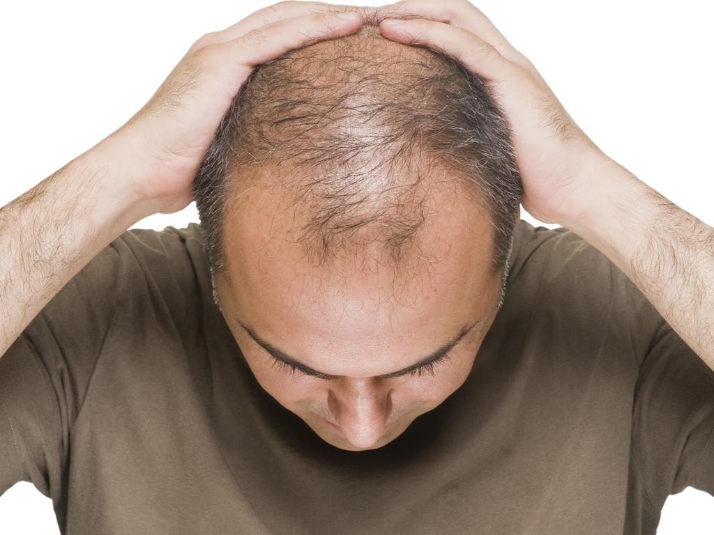 Is baldness caused by high testosterone?