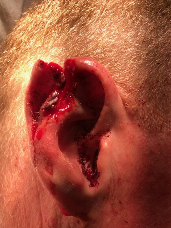 GRAPHIC WARNING: Several other off-duty police officers then allegedly became involved in the altercation where Mr Millington allegedly grabbed off-duty senior constable Terry Masters and bit him on the top of the ear..