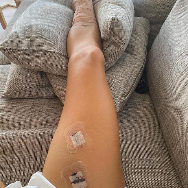 Laura Thrum initially had the mole removed as a precautionary measure. Picture: Instagram/Laura Thrum