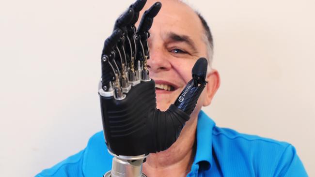 QLD_CP_NEWS_PROSTHETICS_19MAY22