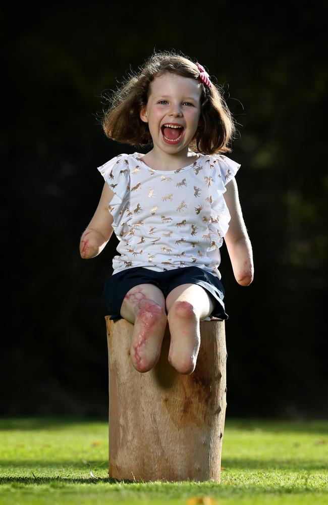 Mia Wilkinson has been happily getting on with life since losing her arms and legs to sepsis. Pictures: Adam Head