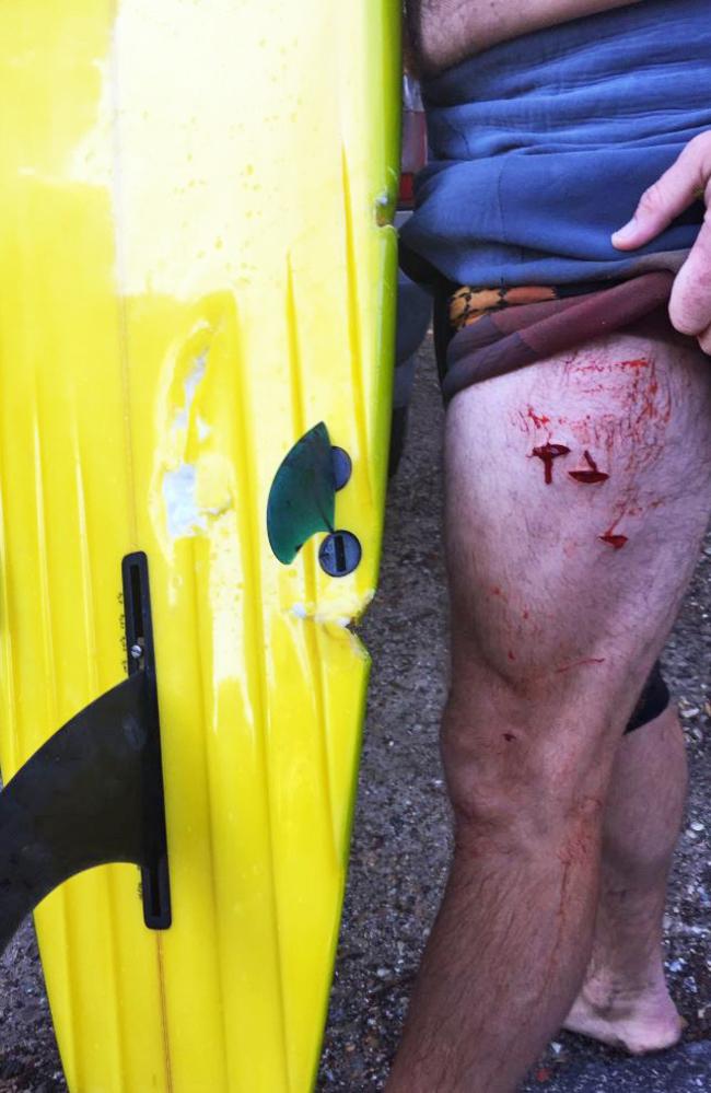 A photo of the injuries sustained by the surfer. Picture: Geoffrey John Knapp