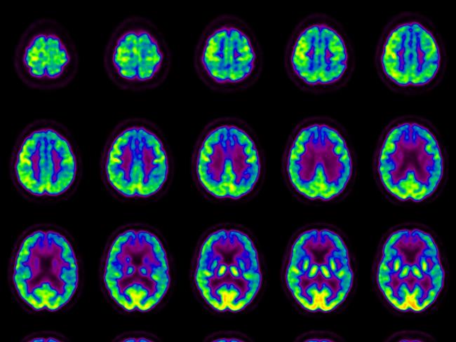 PET scan images show the location of the target, cortisol-producing enzyme in the brain, which the Xananem pill targets.