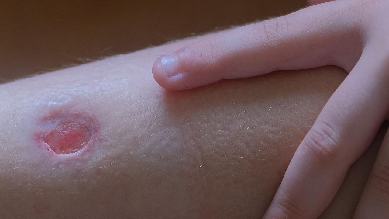 A child with a buruli ulcer on his lower calf. Picture: Mark Wilson
